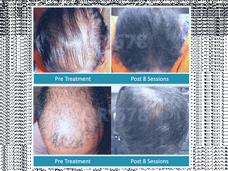 Best & Latest Hair Loss Treatment for Men and Women in India 2021